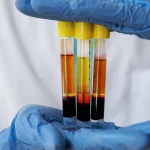 Platelet-rich plasma (PRP) preparation at an orthopedic clinic in Dubai showing separated plasma layers after centrifugation before PRP injection treatment.
