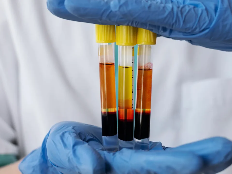 Platelet-rich plasma (PRP) preparation at an orthopedic clinic in Dubai showing separated plasma layers after centrifugation before PRP injection treatment.
