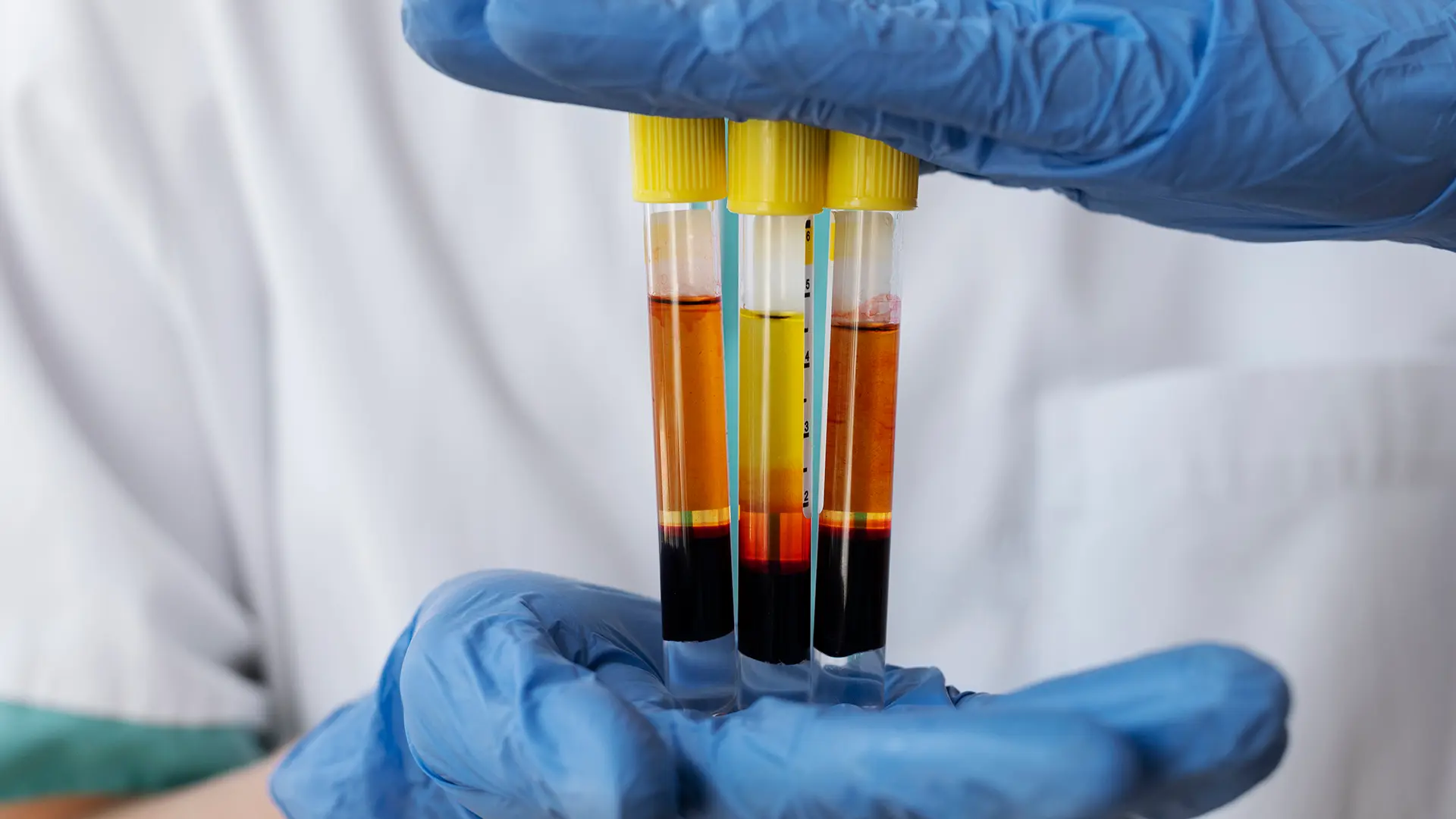 Platelet-rich plasma (PRP) preparation at an orthopedic clinic in Dubai showing separated plasma layers after centrifugation before PRP injection treatment.