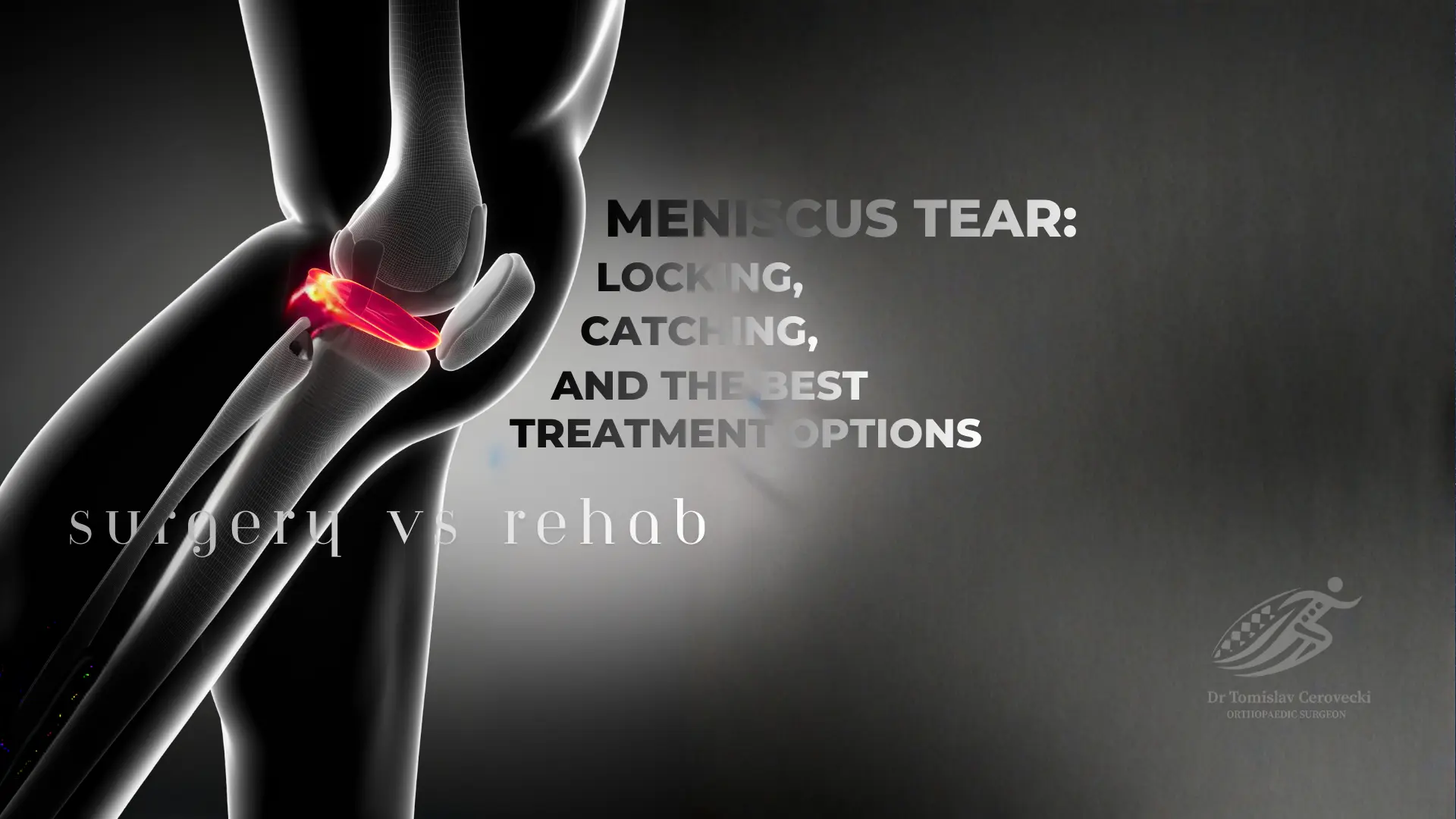Meniscus Tear: Locking vs Catching & Best Treatment (Surgery vs Rehab) Text on the image and there is a gray style leg bone anatomy which emphasize on Meniscus by highlighting it in red color