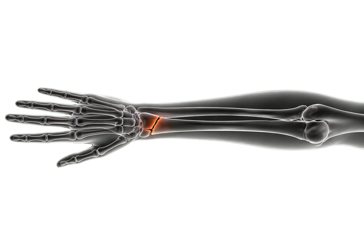 Hand bone fracture Dubai illustration for hand, finger and wrist trauma assessment.