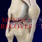 Meniscus surgery recovery timeline banner showing a repaired meniscus in a 3D knee model