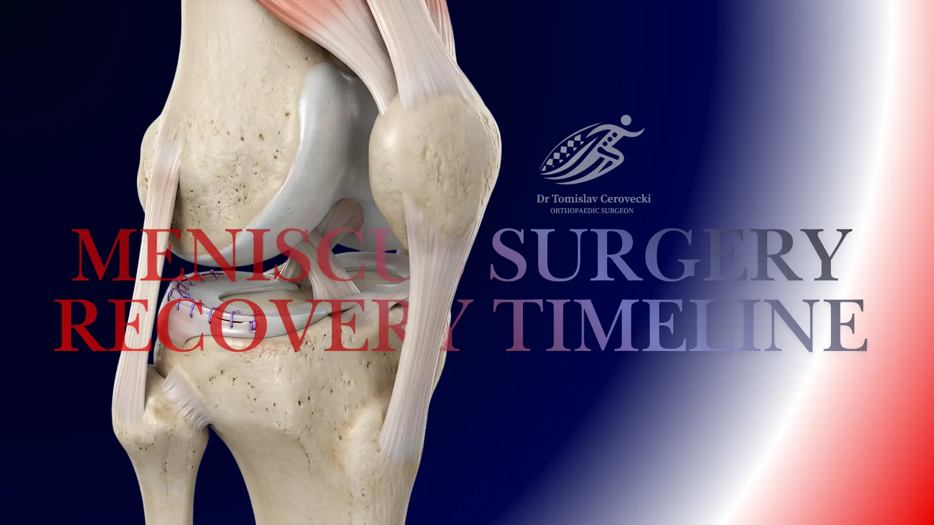 3D knee anatomy illustration showing a sutured meniscus repair for a blog about meniscus surgery recovery timeline by Dr Tomislav Cerovecki.