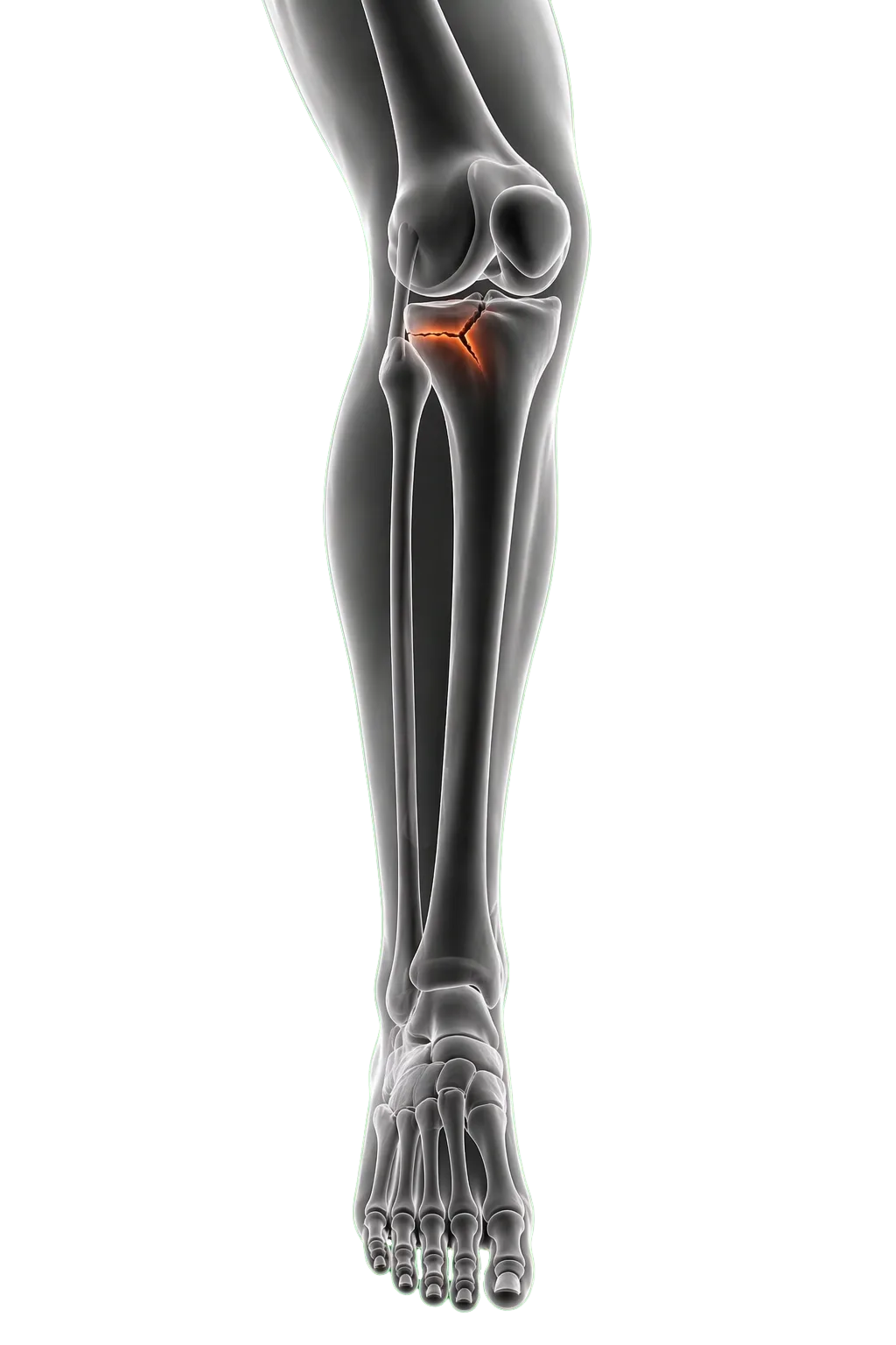 Fractures and sports trauma Dubai illustration showing foot and ankle fracture assessment by Dr. Tomislav Cerovecki.