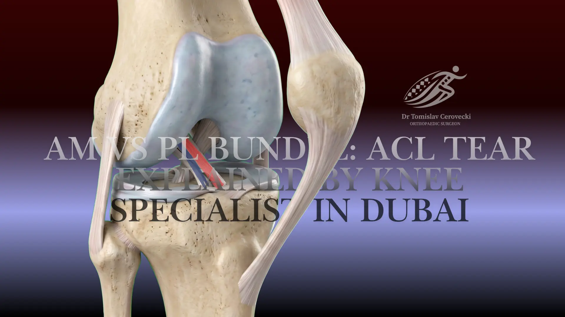 ACL anatomy showing the anteromedial and posterolateral bundle concept in a knee