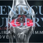 Meniscus surgery explained with metallic knee anatomy and red highlighted meniscus cartilage.
