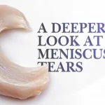 Hyper-realistic close-up of knee meniscus fibrocartilage showing a longitudinal tear along the tissue surface.
