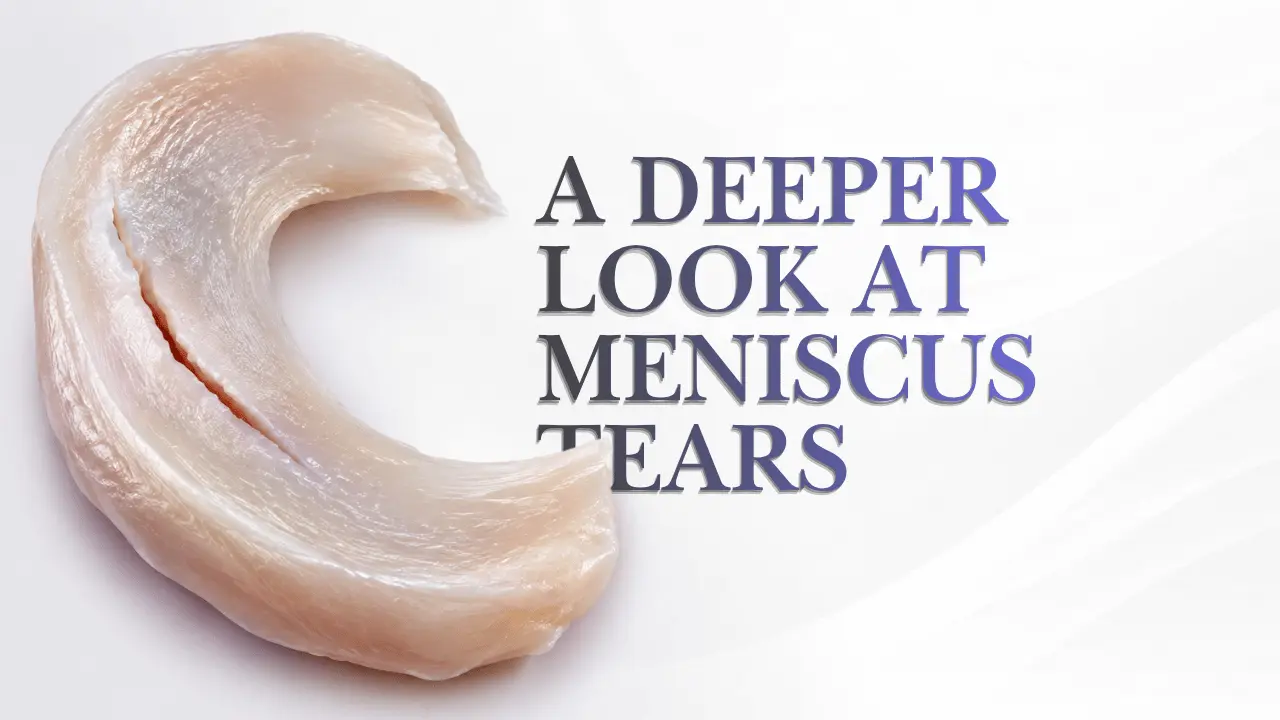 Longitudinal medial meniscus tear medical illustration of the knee