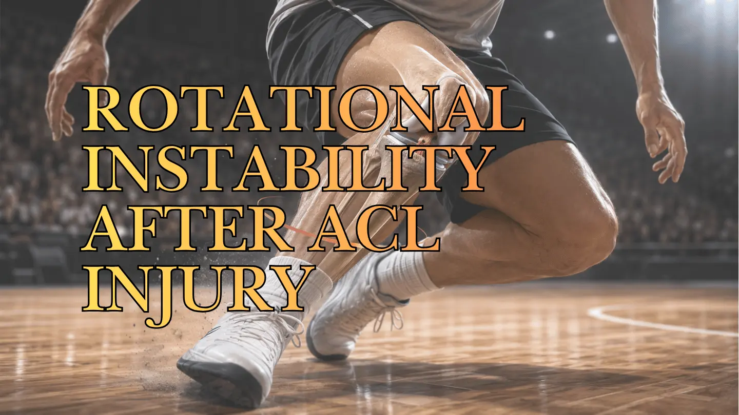 Medical illustration of rotational knee instability after an ACL injury during a pivoting movement.