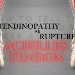 Side-by-side anatomical comparison of Achilles tendinopathy and complete Achilles tendon rupture